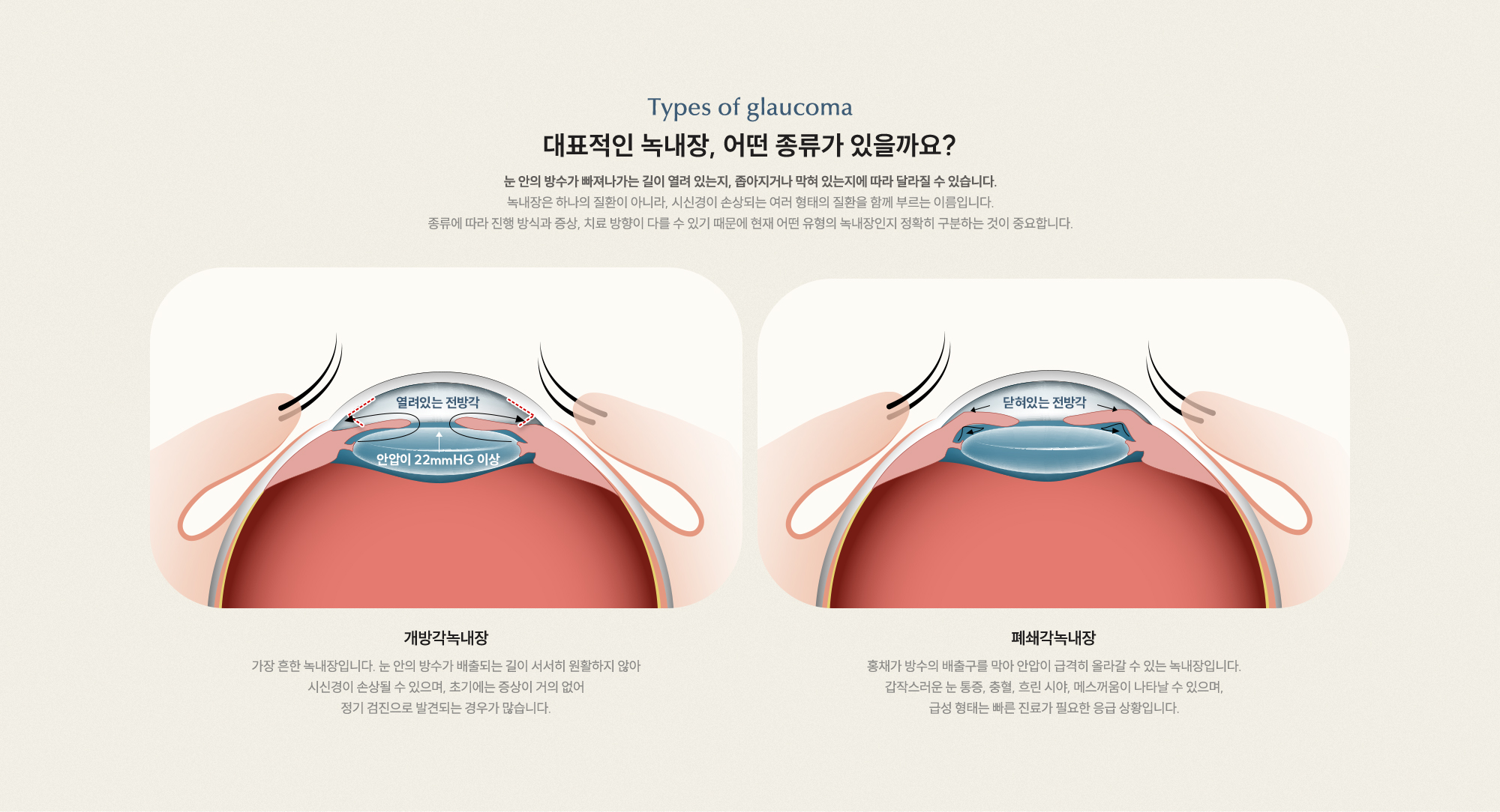 대표적인 녹내장, 어떤 종류가 있을까요? 개방각녹내장 초기엔 증상 거의 없음 폐쇄각녹내장 안압 급상승·응급 상황 가능
