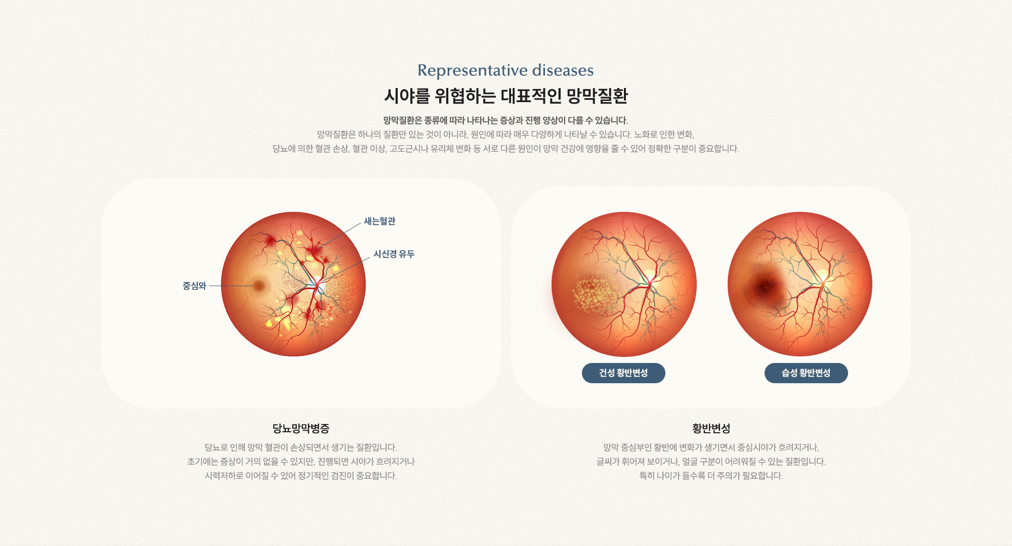 시야를 위협하는 대표적인 망막질환 당뇨망막병증 초기 증상 거의 없음, 황반변성 건성·습성으로 구분, 중심시야 흐려짐
