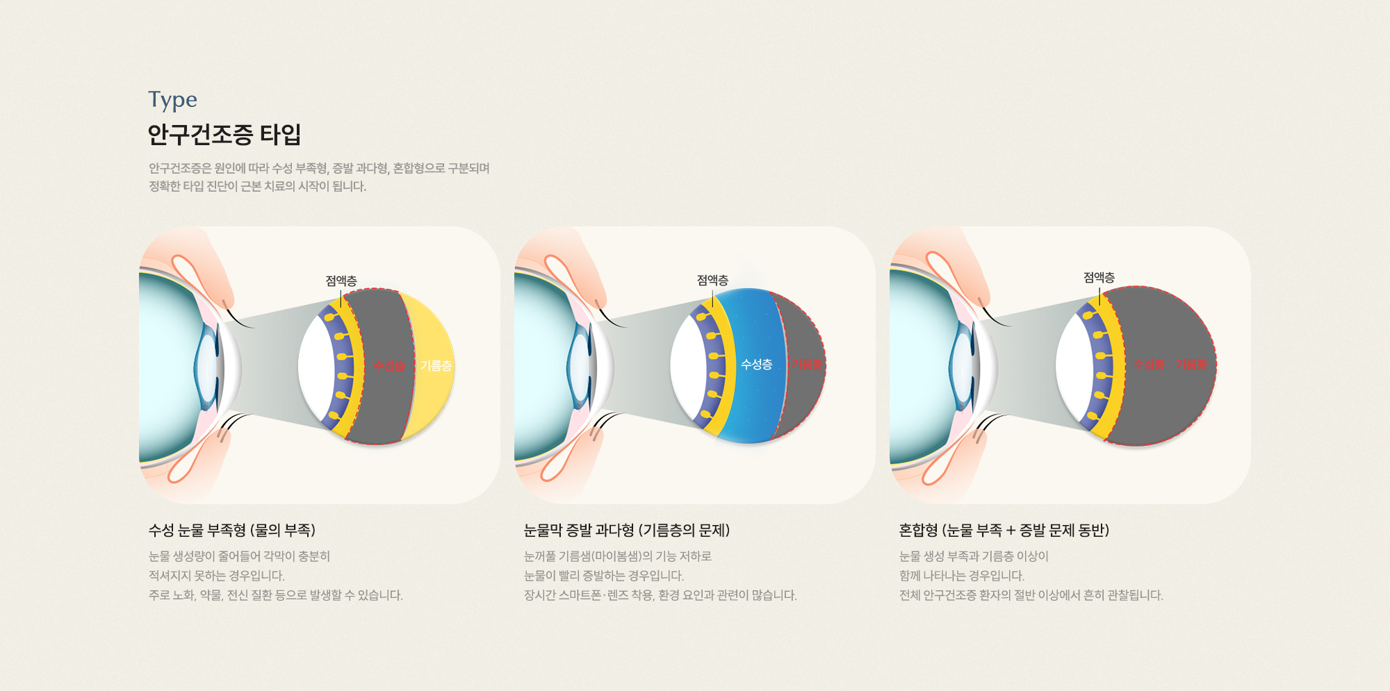 안구건조증 타입 수성 눈물 부족형(물의 부족) 눈물막 증발 과다형(기름층의 문제) 혼합형(눈물 부족+증발 문제 동반)