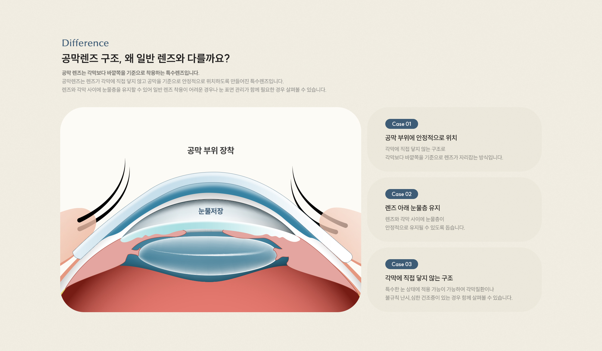 공막렌즈 구조, 왜 일반 렌즈와 다를까요? [Case 01] 공막 부위에 안정적으로 위치 [Case 02] 렌즈 아래 눈물층 유지 [Case 03] 각막에 직접 닿지 않는 구조